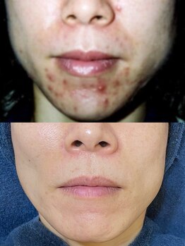 ソリッジ肌管理室/ニキビケアは集中プログラム