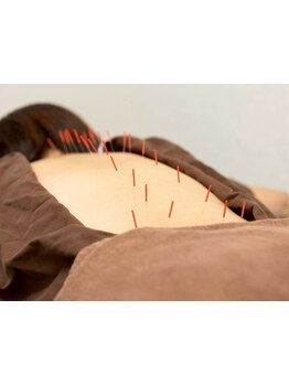 鍼灸施術を受けたい