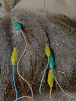 ビーフラット(B-flat)の写真/【NEW☆育毛を促進する鍼灸メニュー登場】75分¥8000→¥6000のクーポン◎気になる方是非お試しくださいませ!