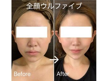 エステサロン ベルジュール/全顔(目元・頬・顎下・おでこ)