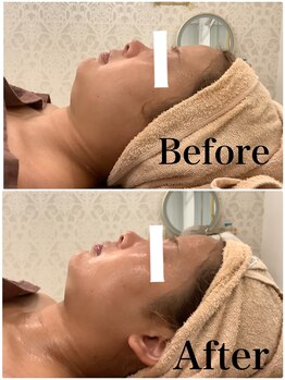 スペチアーレ 夙川/抜群のリフトアップ