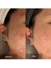 マインエム(mine.m)/こめかみ～フェイスラインニキビ