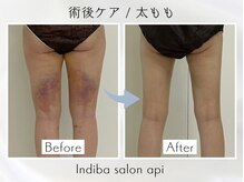 アピ(api)/症例写真【インディバ】