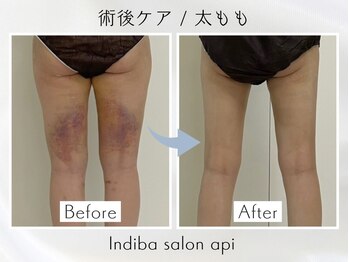 アピ(api)/症例写真【インディバ】