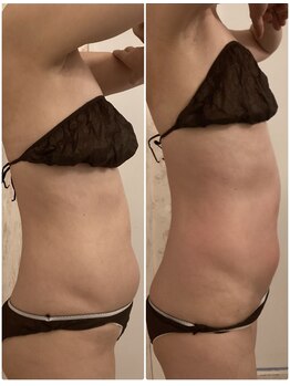 ミューズ 成城(MUSE)の写真/【痩身・ダイエット・リンパマッサージ・発汗】引き締め!脂肪やハリ、浮腫み解消、サイズダウン美ボディを
