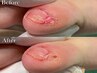副爪2箇所（小指の爪横にある爪ではないモノ）【魚の目までケア】　¥6,600