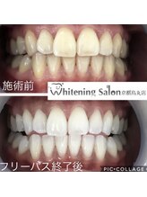 ホワイトニングサロン 京都烏丸店/ホワイトニング施術例