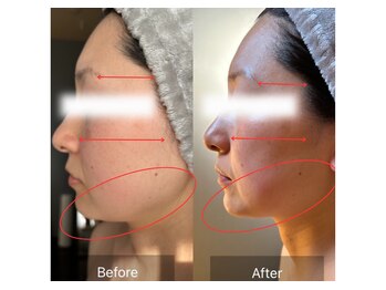 ラシェリー(La Cherie)/小顔効果