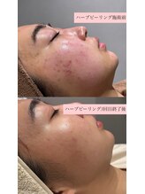 ラヴィン なんばスカイオ店(Lovin)/【ハードハーブピーリング 4回】