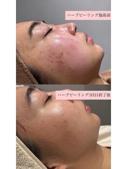 ラヴィン なんばスカイオ店(Lovin)/【ハードハーブピーリング 4回】