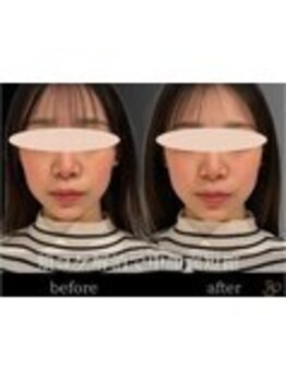 チョコバリ 錦糸町店(chocobari)/小顔×リフトアップ(美容鍼)20代