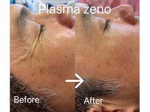 エステサロン ベルジュール/目元の小じわ