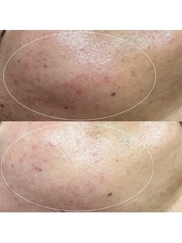 ソワ 吉塚店(soi)/赤み、ざらつきも改善!