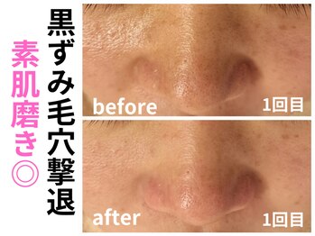 エリン(ERIN)/毛穴徹底洗浄