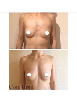 ベルビューティー(belle beauty)/【バストアップ☆育乳】◇症例◇