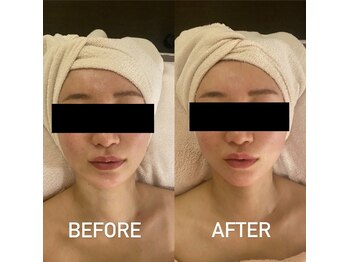 メイロン(meilong)/小顔マッサージ