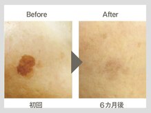 ビューティーリバース 相模大野店/シミケア美白！オセロマシン