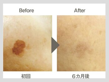 ビューティーリバース 相模大野店/シミケア美白！オセロマシン