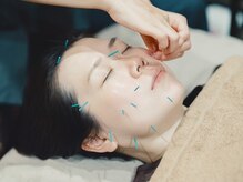 女性鍼灸師による心地よい鍼灸施術。