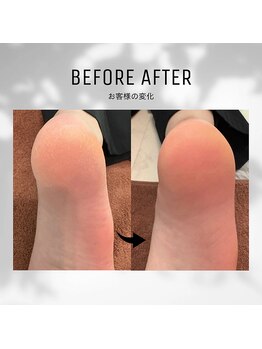 ビューティーサロンレモン(Lemon)/かかとクイックピーリング