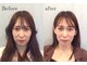 アウン(aum)の写真/定番人気メニュー☆"美容鍼＋小顔矯正＋背骨矯正″リフトアップ・たるみ・小顔に効果的◎間違いなし