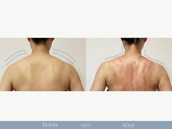 エパニ(epani)の写真/    肩・首のつらさと、もっこり肩が気になる方へ。軽やかに、すっきりした後ろ姿へ