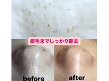 ビューティーネイル(Beauty Nail)/毛穴エクストラクション