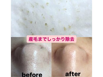 ビューティーネイル(Beauty Nail)/毛穴エクストラクション