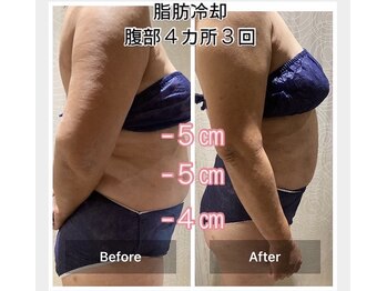 ラベージャ(La Bella)/脂肪冷却