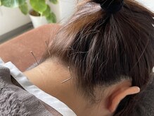 アイリス鍼灸 マッサージヴィラ(Iris鍼灸 マッサージvilla)