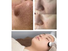 エスボーテ(sbeaute)の雰囲気（夏に増える毛穴の黒ずみ。毛穴洗浄、学生さんにも人気メニュー）