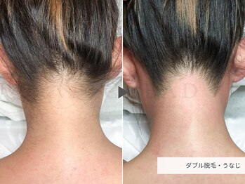 クリード(CLEAD)/うなじワックス脱毛/3500円