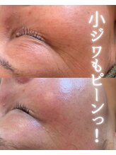 リルビー(Lilby)/エイジング・ハーブピーリング