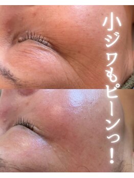 リルビー(Lilby)/エイジング・ハーブピーリング