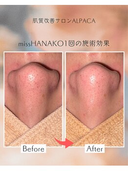 アルパカ(ALPACA)/missHANAKO