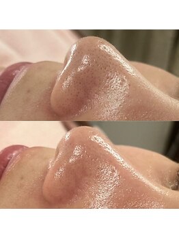 シンディー(CINDY)/毛穴洗浄