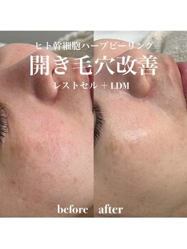 イロハ(IROHA)/開き毛穴改善!