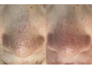 シレーヌ(Sirene)/黒ずみ毛穴|ざらつき肌改善