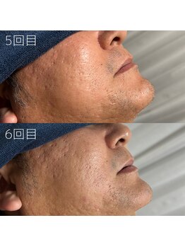 カナウ(KANAU)/ヒゲ脱毛（40代後半男性）