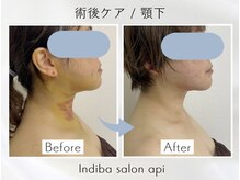 アピ(api)/症例写真【インディバ】