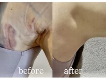 サロン(SALON)の雰囲気(【二の腕の吸引】浮腫/腫れ/内出血緩和/術後インディバ/DT短縮)
