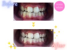 エクシアホワイトニング 石巻店/ホワイトニングサロン　石巻店