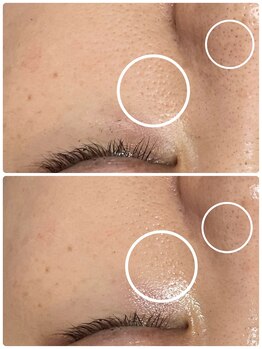 ケイサロン 朝霞店(K salon)/ハーブピーリングbefore・after