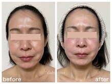 ダルセーニョ/１回で「脂肪なだれ」リセット！