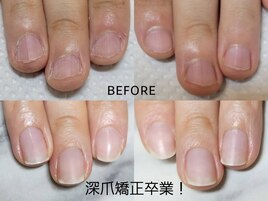 深爪矯正卒業