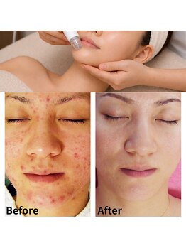 クリニカルエステクリア 梅田店の写真/繰り返すニキビ毛穴・開きを同時改善｜原因から整える専門ケア！肌質分析付き根本改善集中プログラム
