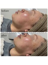 ナビ(NAVI)/たるみに特化！ピーチリフト