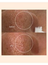 レア(Lea)/旅行前にお肌を綺麗に♪