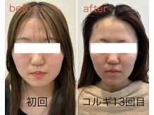 ビーキュート 姫路店(BE-CUTE)/小顔コルギ13回目