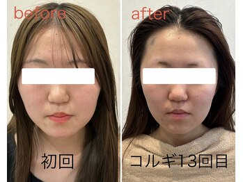 ビーキュート 姫路店(BE-CUTE)/小顔コルギ13回目